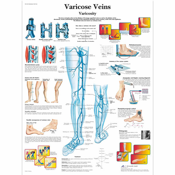 Varicose Veins Anatomical Chart Ceilblue